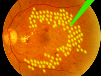 ARGON_LASER-DIABETES2