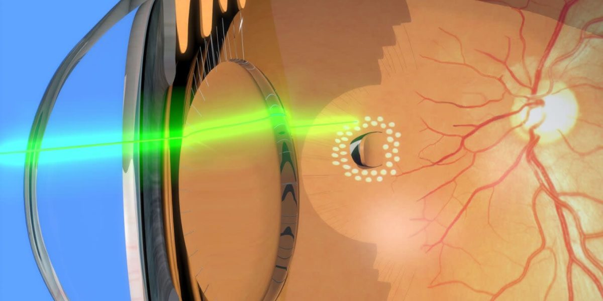 ARGON_LASER_ROGMI2