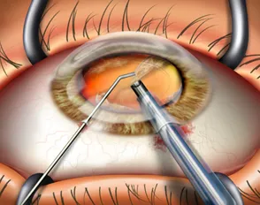 CATARACT2
