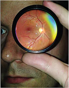 FUNDOSCOPY2
