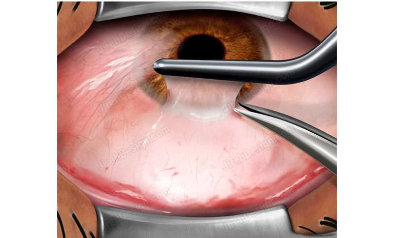 PTERYGIUM2