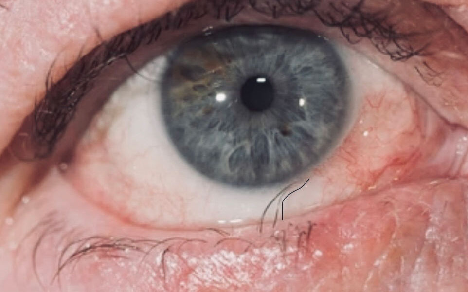 TRICHIASIS2