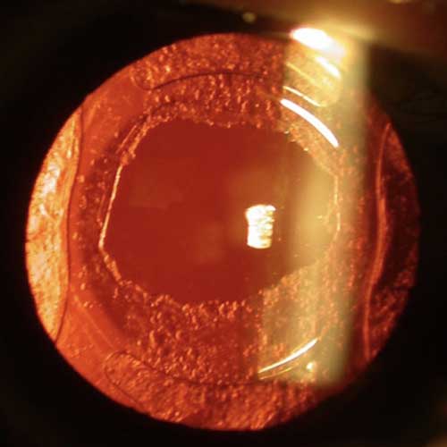 YAG_LASER_CAPSULOTOMY2